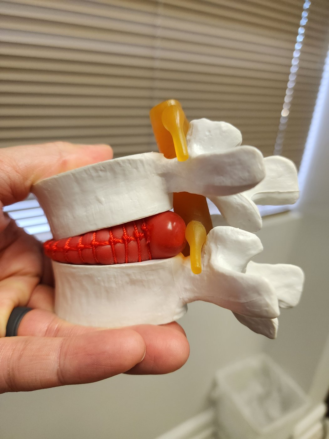 Disc model held by Dr. Hayes showing a bulging disc pressing on a spinal nerve at Bonesetters in Chesterfield, MO
