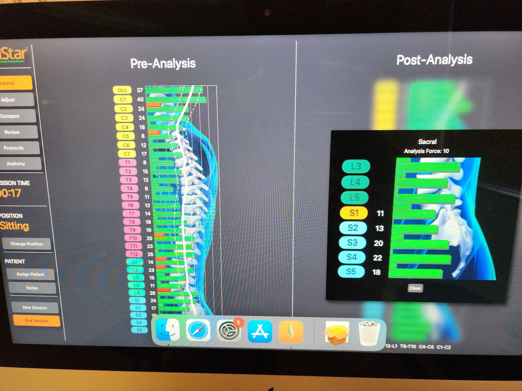 PulStar computer-guided spinal analysis screen showing pre and post readings