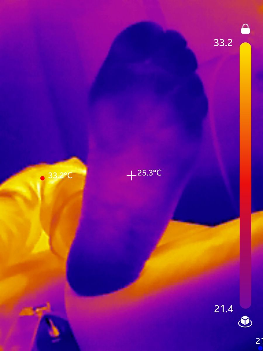 Thermal imaging scan of a foot showing circulation patterns in peripheral neuropathy assessment