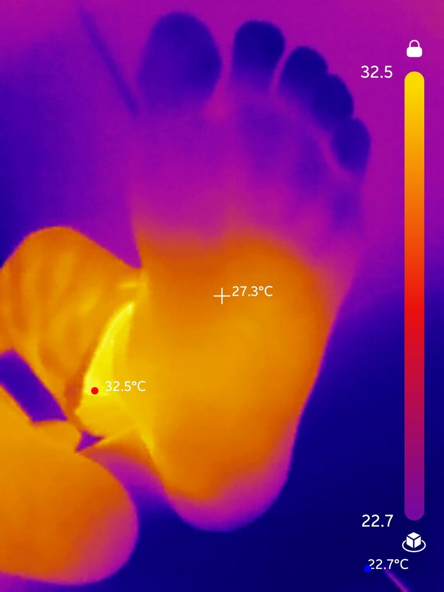 Thermal imaging scan showing circulation patterns in the feet of a neuropathy patient at Bonesetters